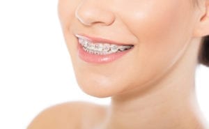 women smiling with braces